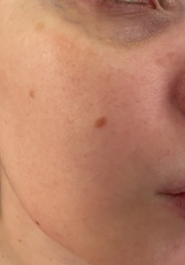 skin before using LED mask 